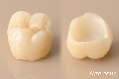 白い奥歯の被せ物